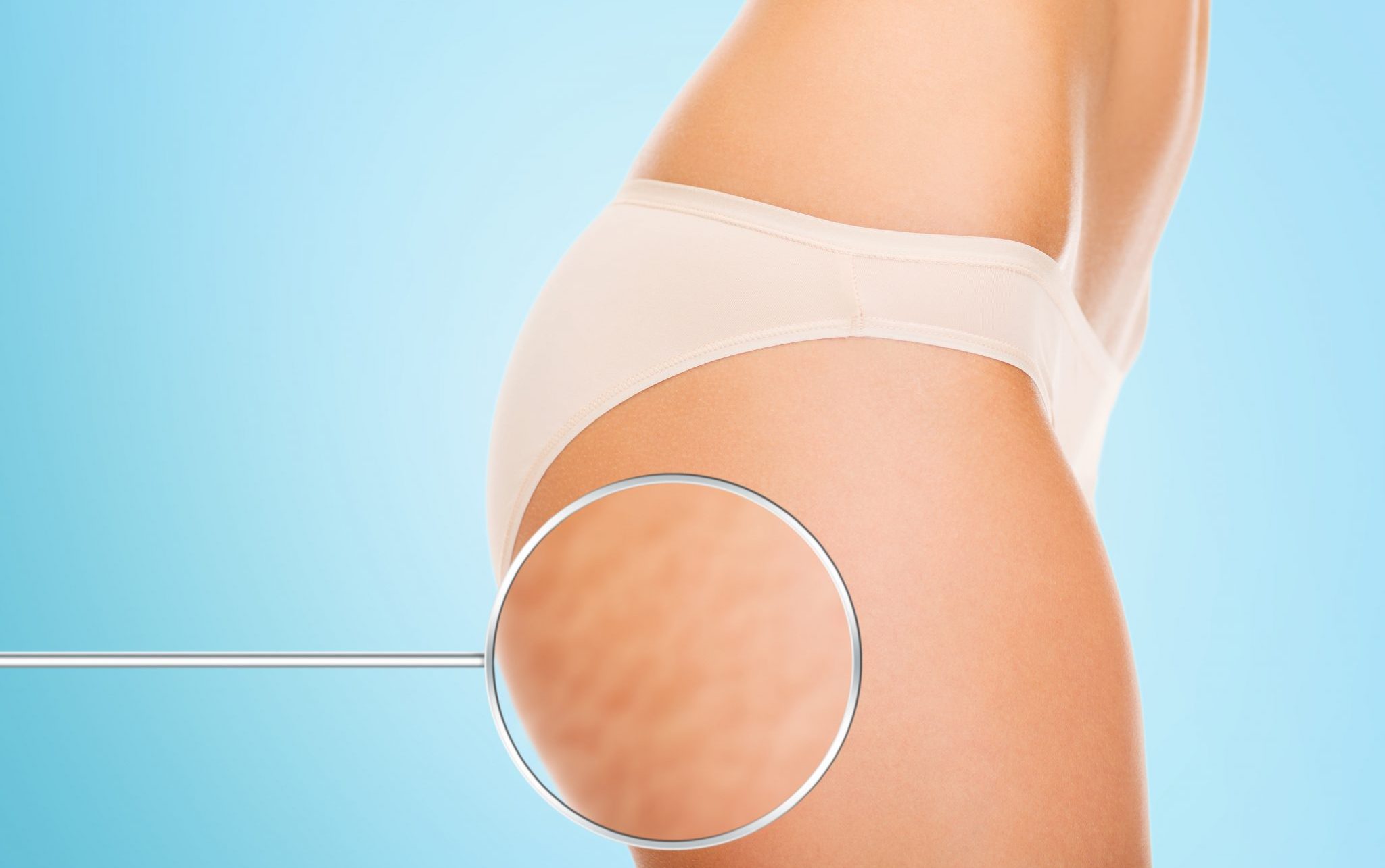 The smart Trick of Cellulite: A Review Of Its Anatomy, Physiology And Treatment That Nobody is Talking About thumbnail