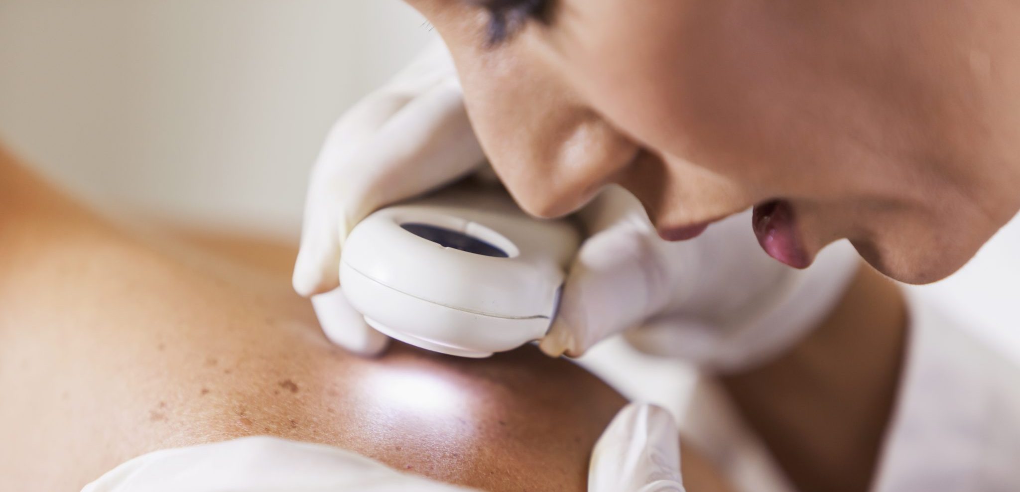 What to Watch Out For – Early Signs of Skin Cancer