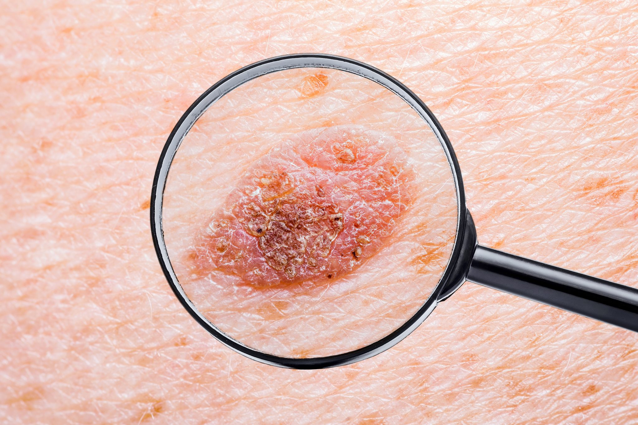 What To Watch Out For Early Signs Of Skin Cancer