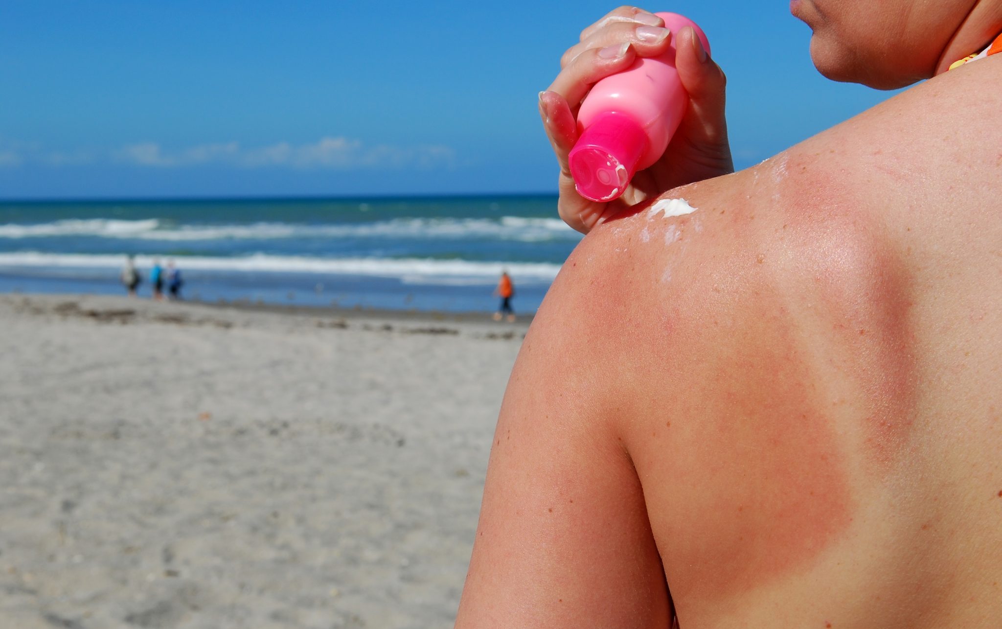 Differences Between Sunburn, Sun Poisoning, Heat Rash, Heat Exhaustion