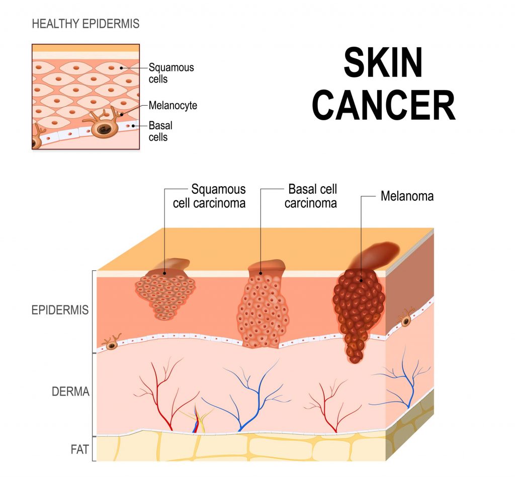 skin-cancer-signs-symptoms-the-dermatologist-s-essential-guide